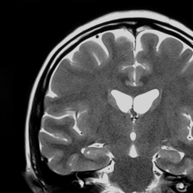 MRI of the brain